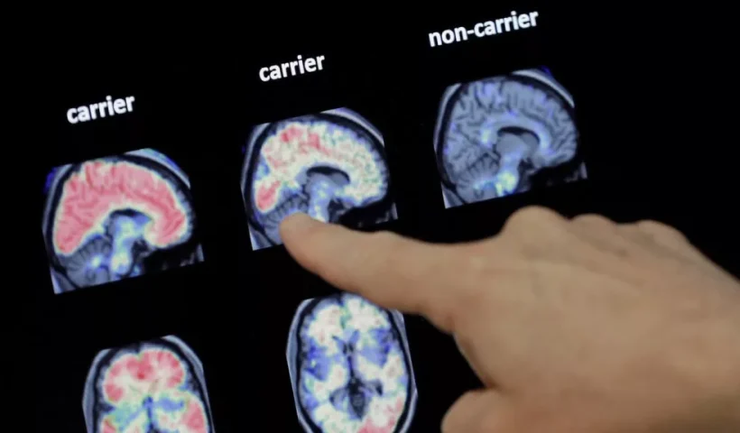 دانشمندان از کشف علت جدید ابتلا به آلزایمر در ماده سفید مغز خبر می‌دهند