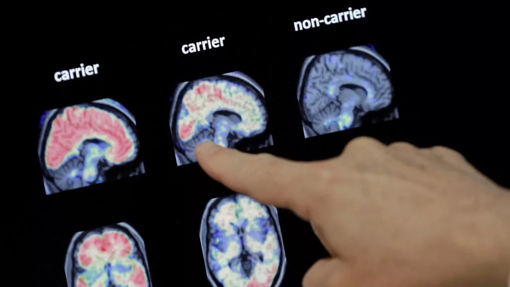 دانشمندان از کشف علت جدید ابتلا به آلزایمر در ماده سفید مغز خبر می‌دهند